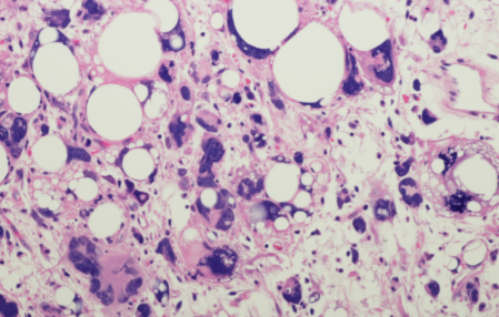 Liposarcoma