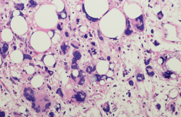 Liposarcoma